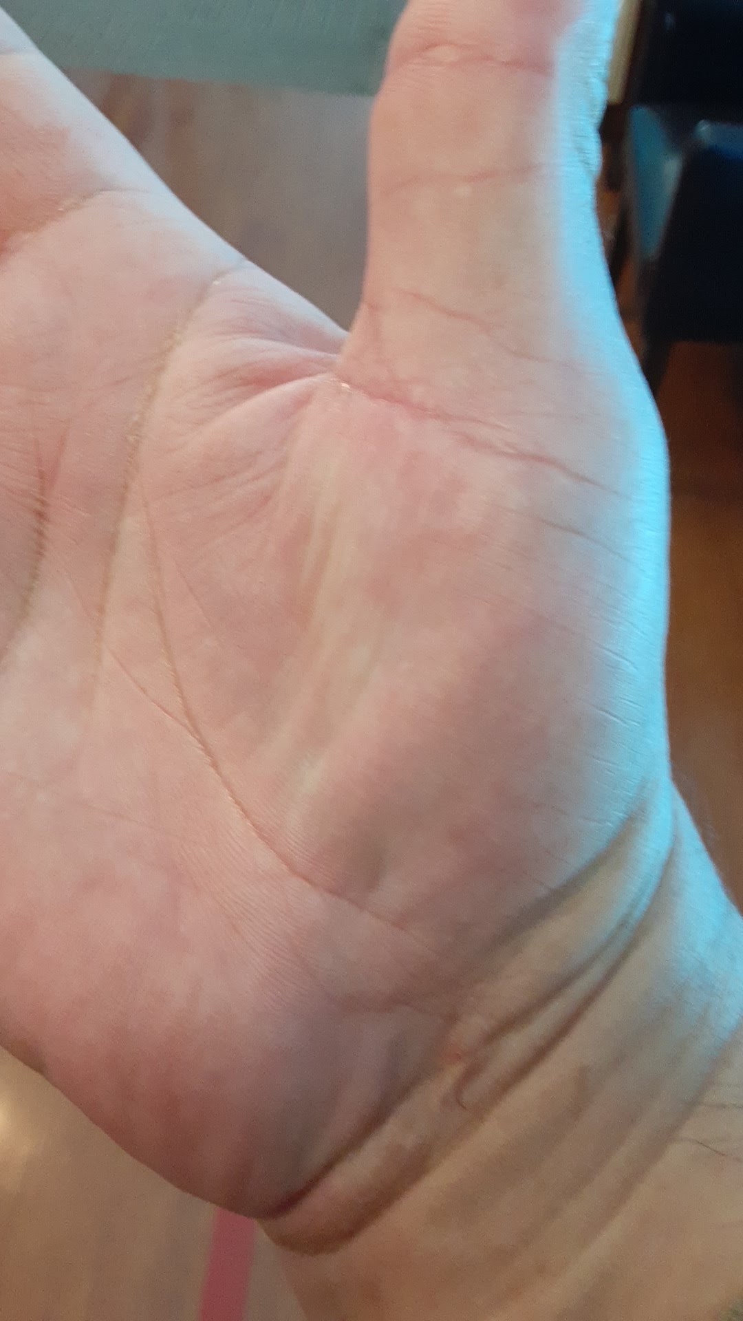FORM Hand Therapy